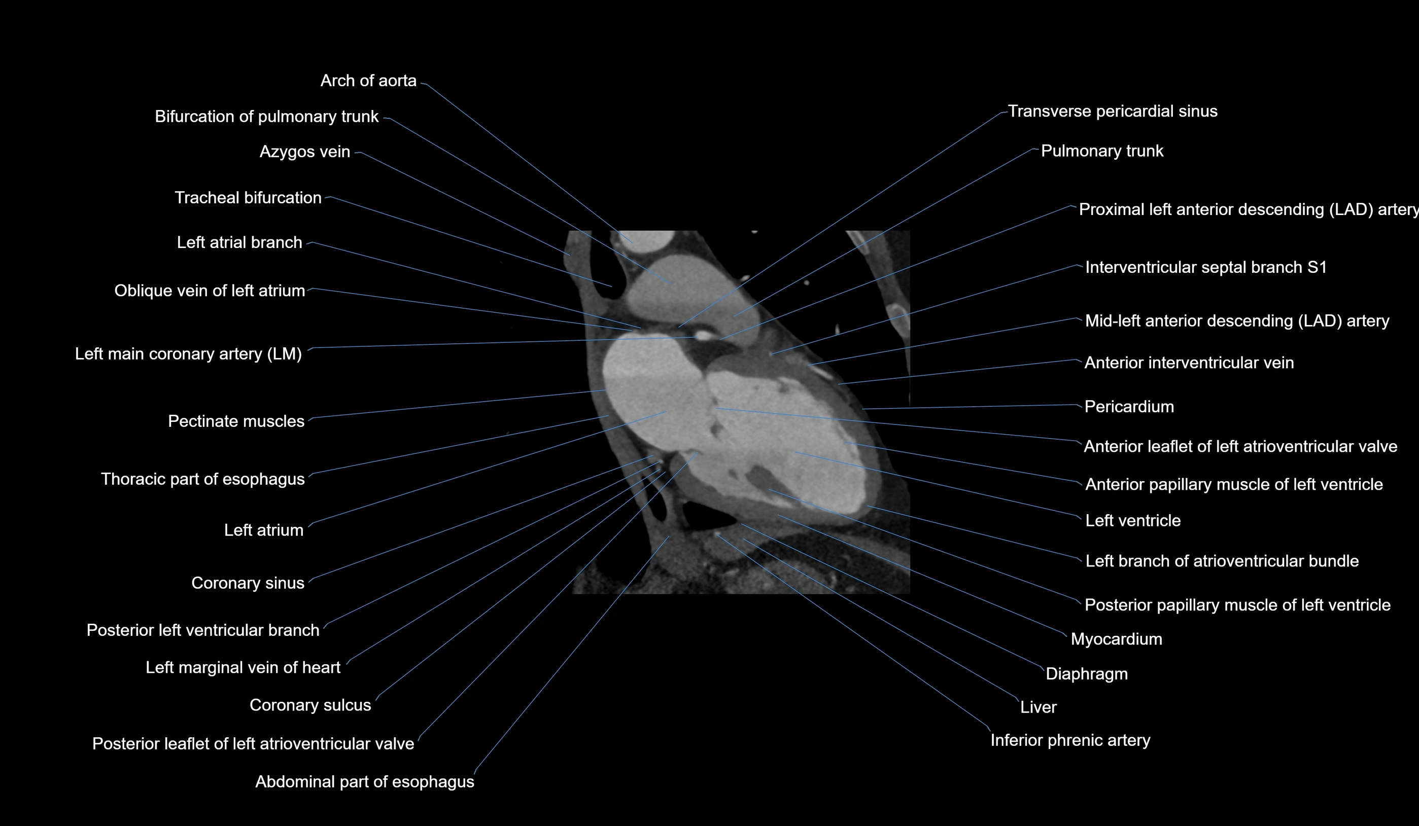 CT heart (coronary angiogram) 2 chamber view cross sectional anatomy labelled radiology image-00016.webp